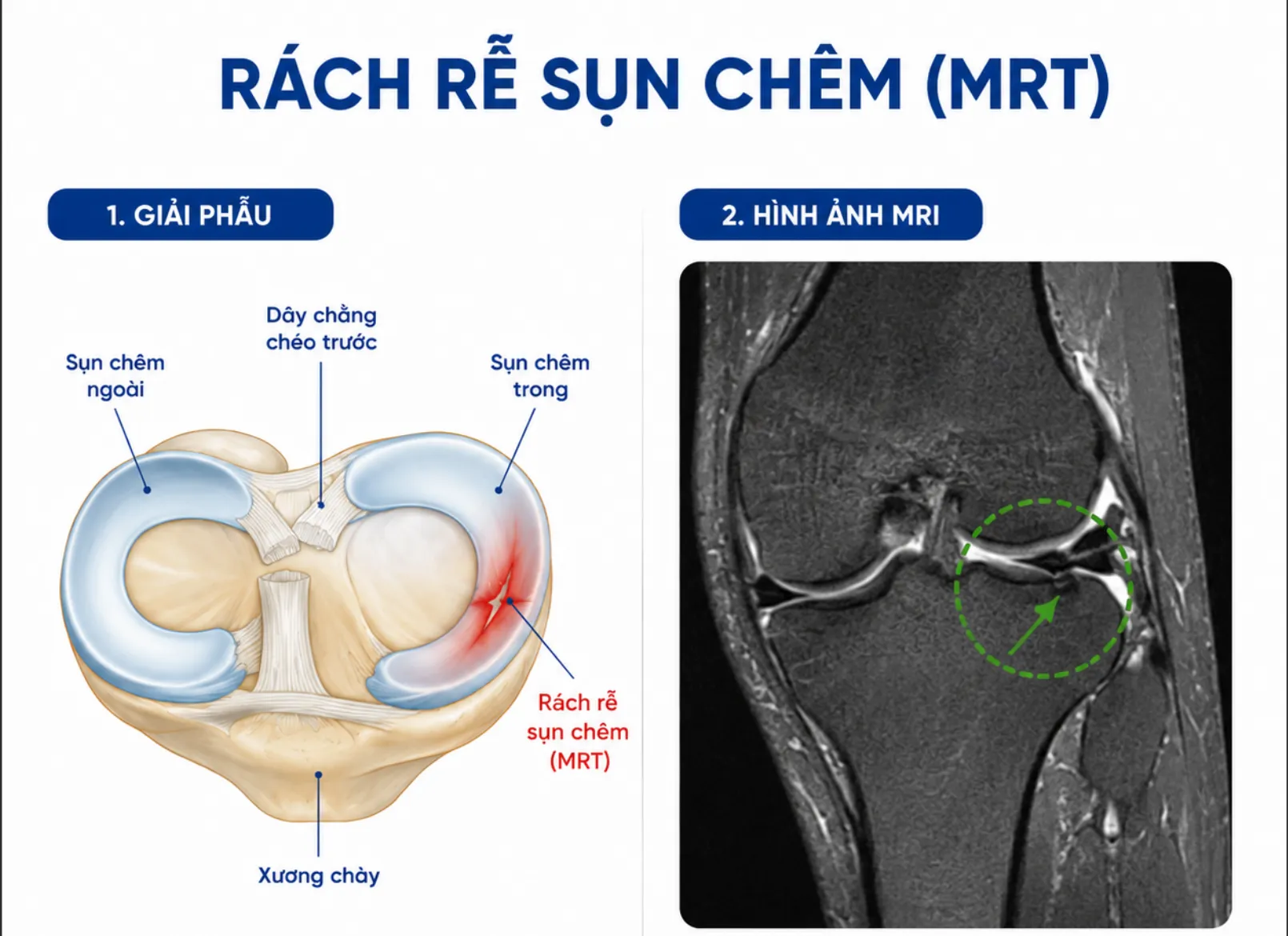 RÁCH RỄ SỤN CHÊM (Meniscal Root Tear)