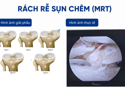 Hiểu đúng về Rách rễ sụn chêm (Meniscal Root Tear)
