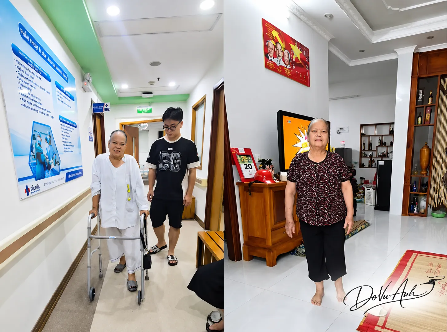 Bệnh nhân 77 tuổi phục hồi vận động tốt sau phẫu thuật thay khớp háng bằng đường mổ SuperPath
