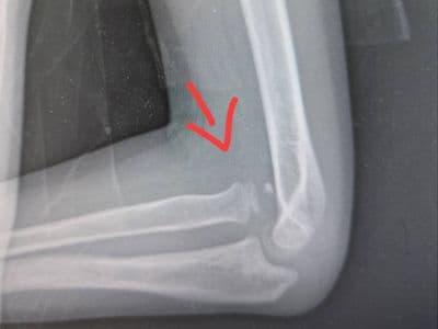 Tìm hiểu về Gãy Monteggia mạn tính