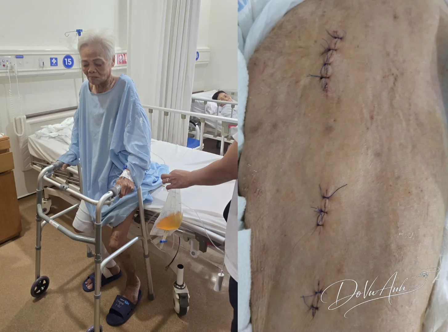 Đinh PFNA – Giải pháp tuyệt vời cho gãy liên mấu chuyển hoặc dưới mấu chuyển ở người cao tuổi