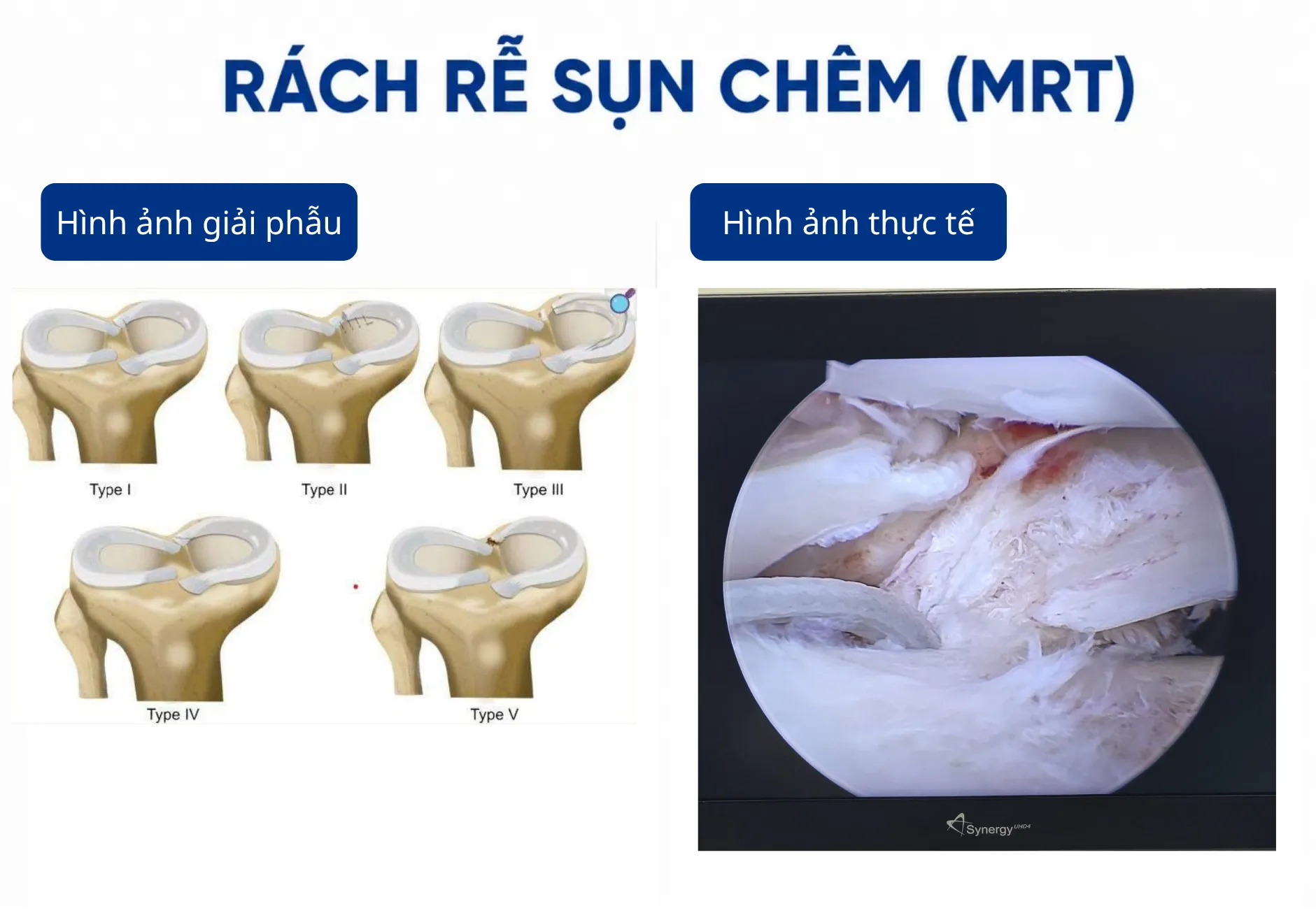 Hiểu đúng về Rách rễ sụn chêm (Meniscal Root Tear)