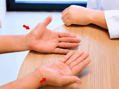 Teo Cơ Ô Mô Cái Do Hội Chứng Ống Cổ Tay: Biến Chứng Nguy Hiểm Khó Hồi Phục