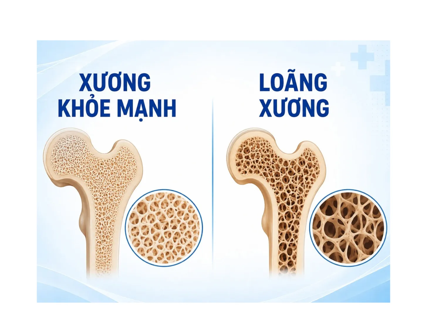 Loãng xương - Nguyên nhân thầm lặng dẫn đến gãy cổ xương đùi ở người cao tuổi