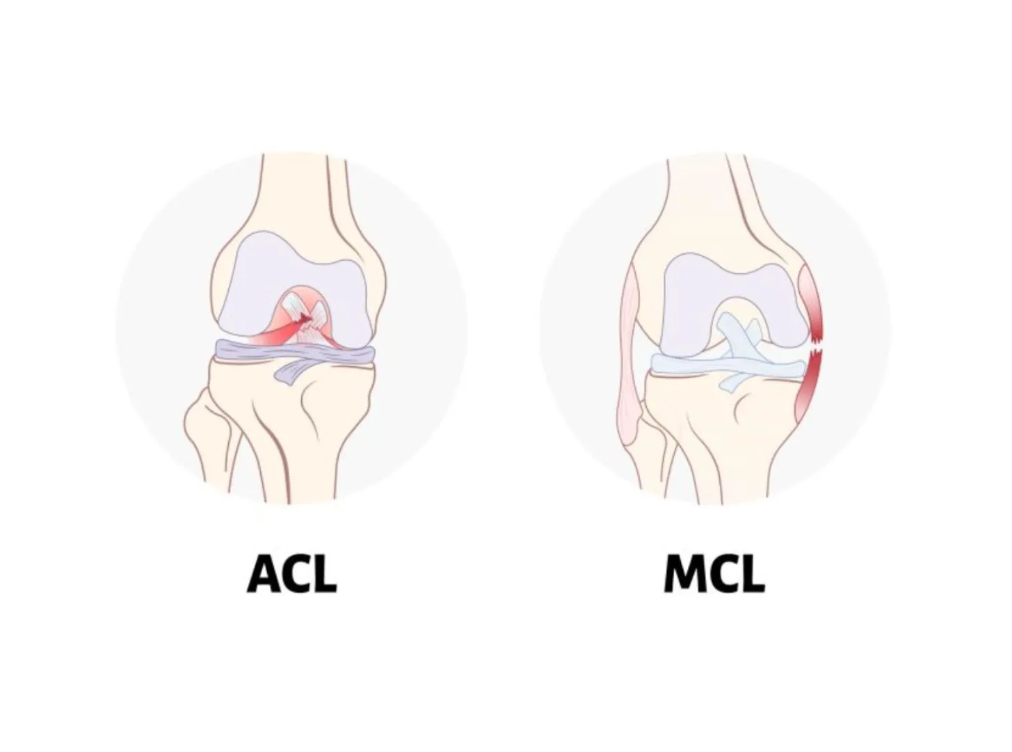 Tổn thương đa dây chằng khớp gối: Dây chằng chéo trước (ACL) và dây chằng bên trong (MCL)