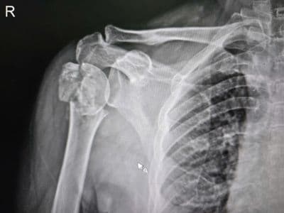 Phẫu thuật kết hợp xương, khâu thẩm mỹ và dán keo sinh học cho gãy phức tạp đầu trên xương cánh tay ở người cao tuổi