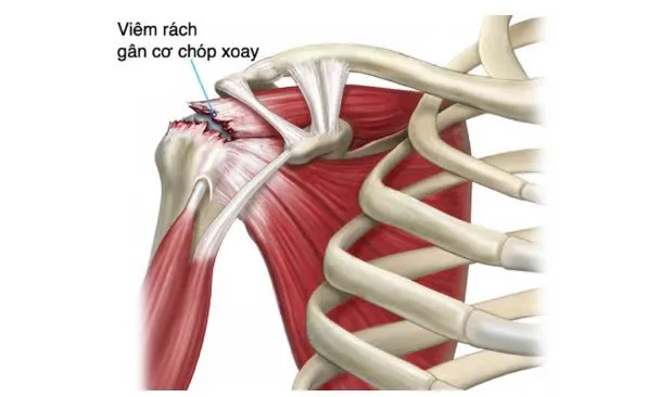 Tìm Hiểu Về Rách Chóp Xoay Vai: Dấu Hiệu, Nguyên Nhân Và Phương Pháp Can Thiệp