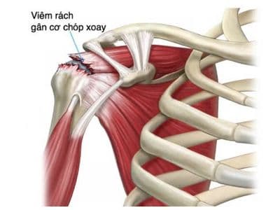 Tìm Hiểu Về Rách Chóp Xoay Vai: Dấu Hiệu, Nguyên Nhân Và Phương Pháp Can Thiệp