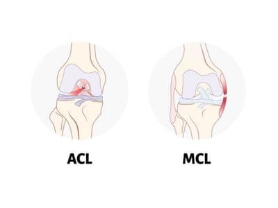 Tổn thương đa dây chằng khớp gối: Dây chằng chéo trước (ACL) và dây chằng bên trong (MCL)