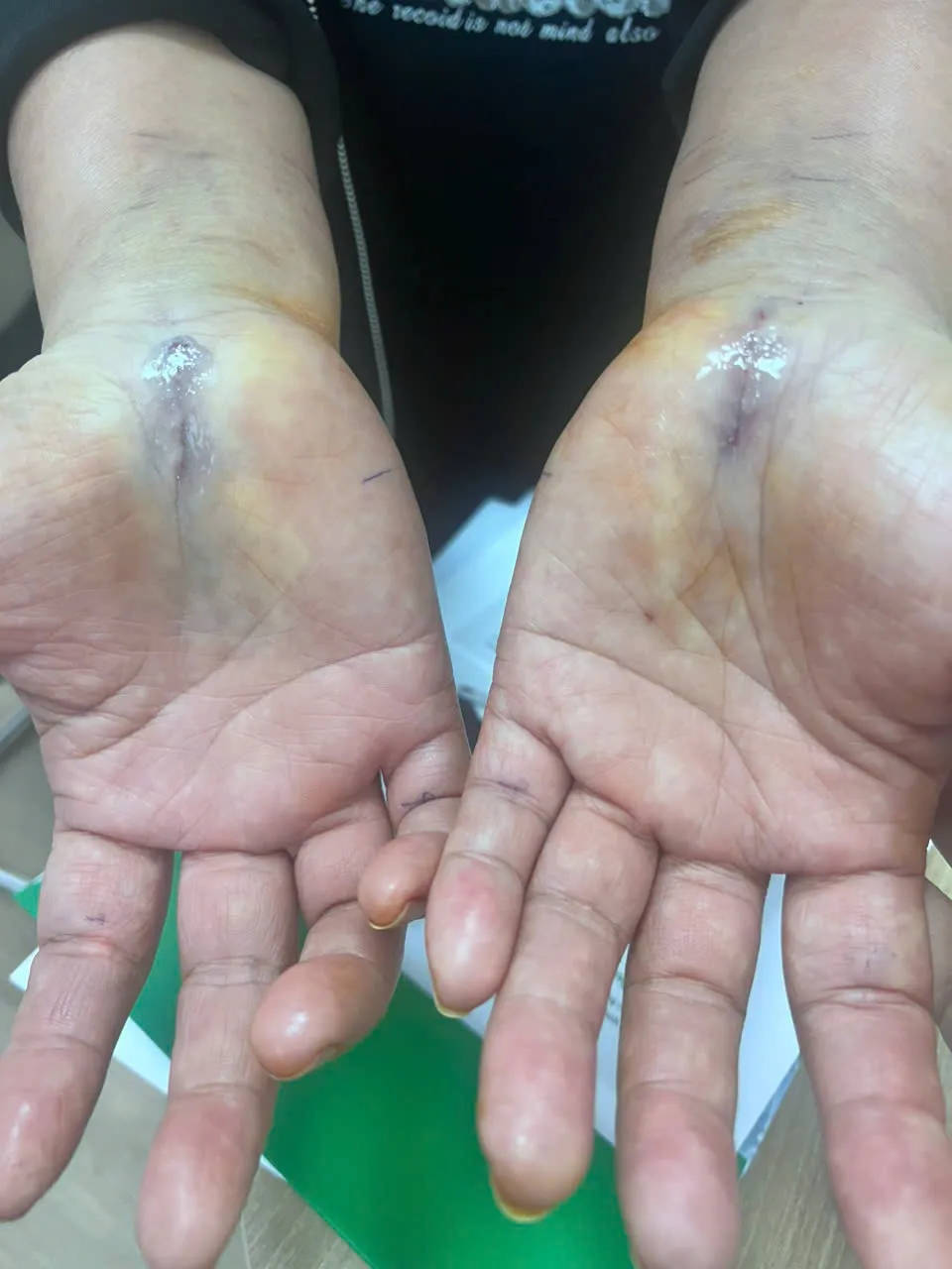 Bất ngờ với phương pháp phẫu thuật không dùng chỉ khâu, không thay băng, cắt chỉ