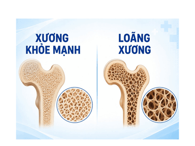 Loãng xương - Nguyên nhân thầm lặng dẫn đến gãy cổ xương đùi ở người cao tuổi