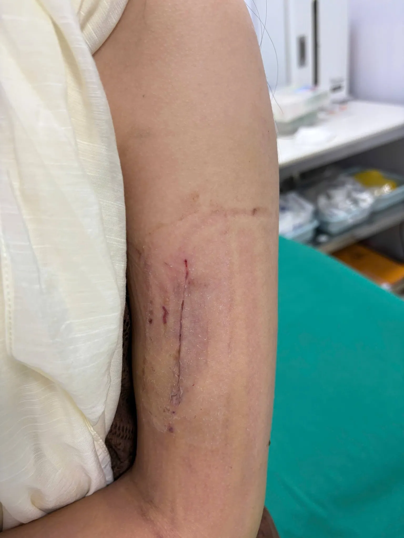 Dẫn Lưu Hay Không Dẫn Lưu Trong Chấn Thương Chỉnh Hình? 