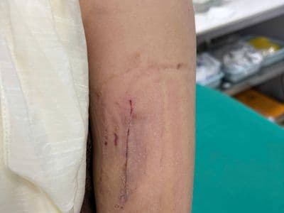Dẫn lưu hay không dẫn lưu trong chấn thương chỉnh hình? 